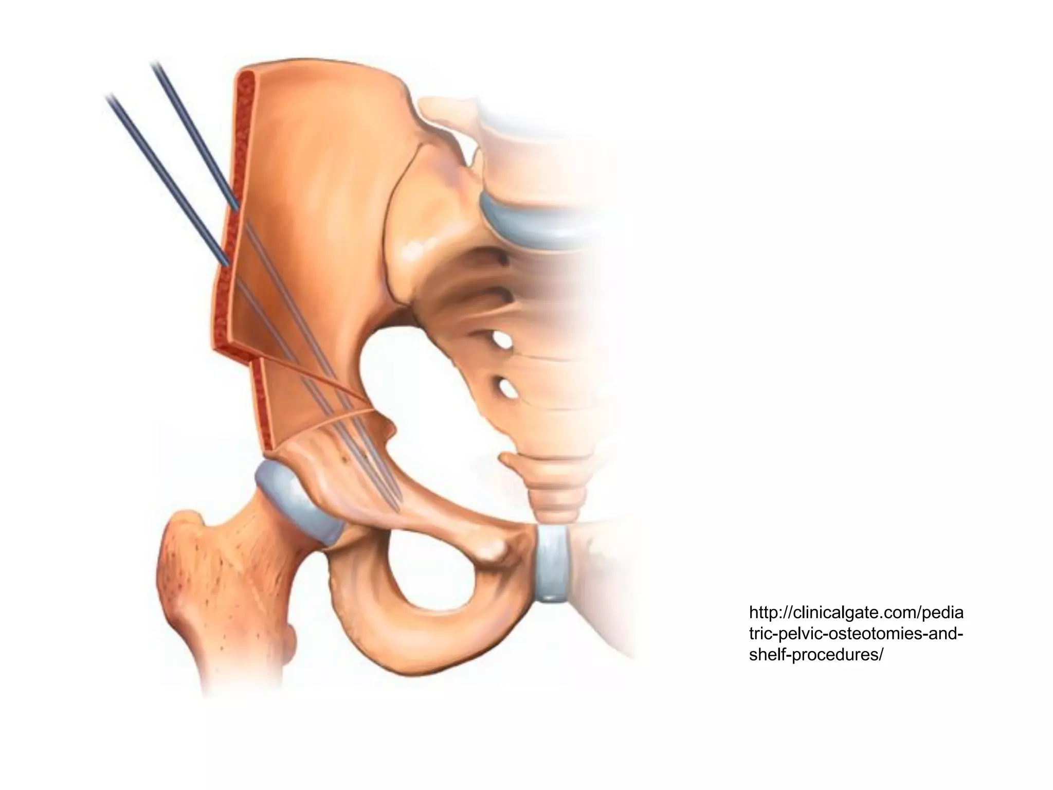 http://clinicalgate.com/pedia
tric-pelvic-osteotomies-and-
shelf-procedures/
 