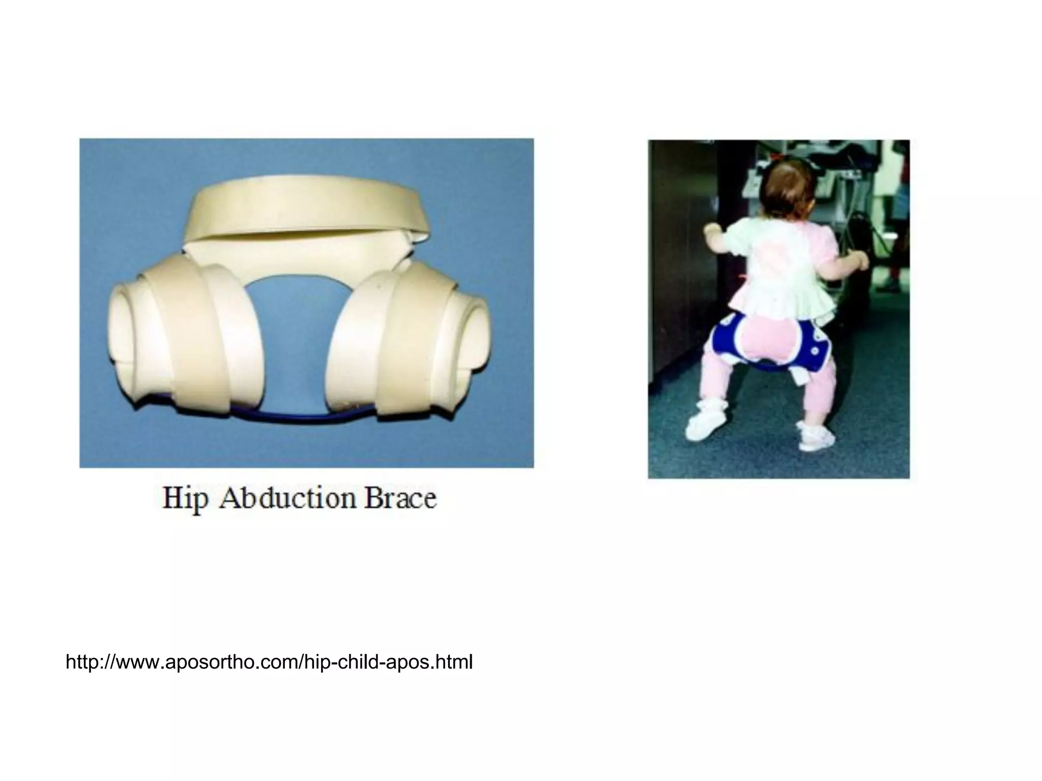 http://www.aposortho.com/hip-child-apos.html
 