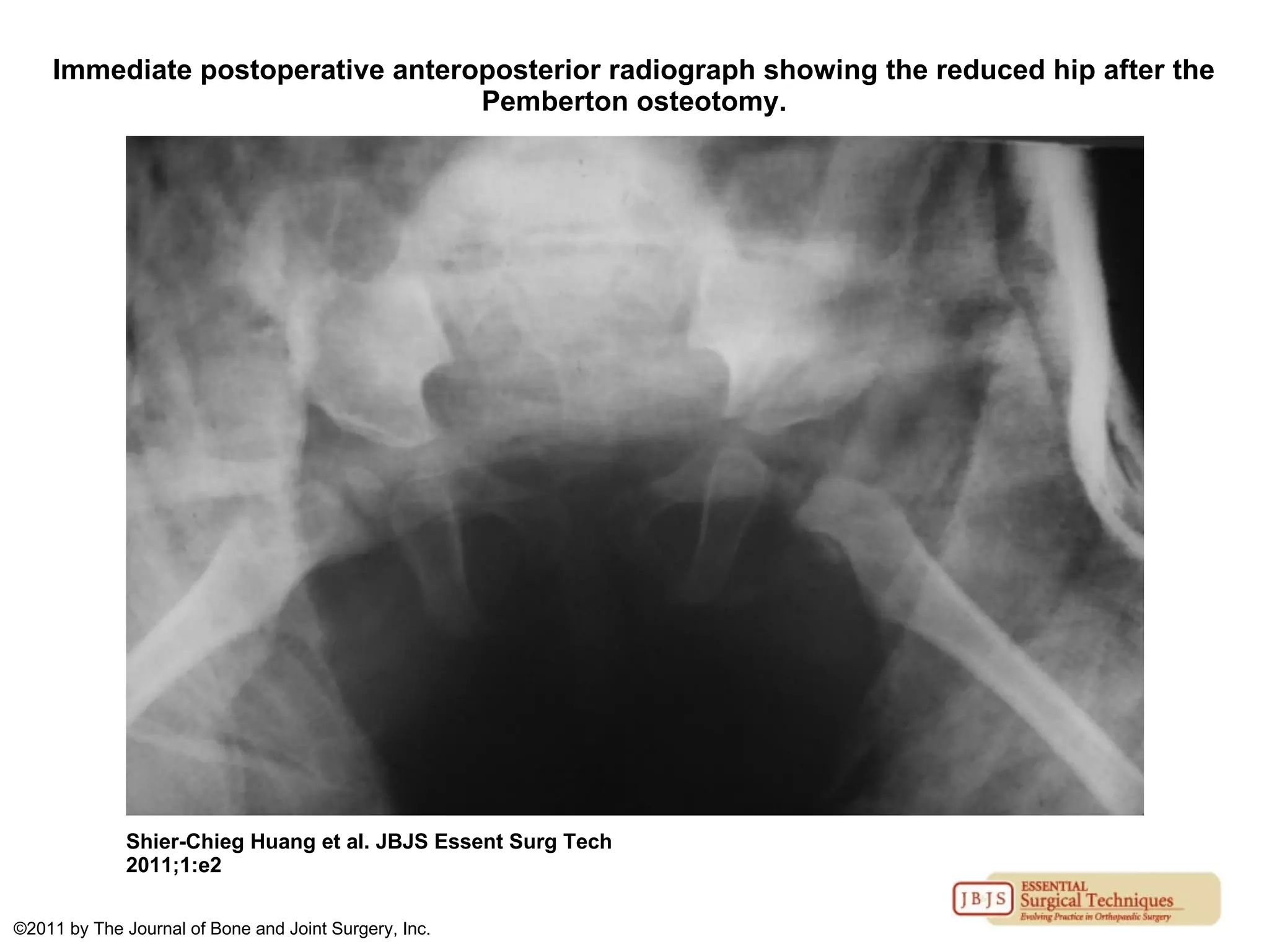 Immediate postoperative anteroposterior radiograph showing the reduced hip after the
Pemberton osteotomy.
Shier-Chieg Huang et al. JBJS Essent Surg Tech
2011;1:e2
©2011 by The Journal of Bone and Joint Surgery, Inc.
 