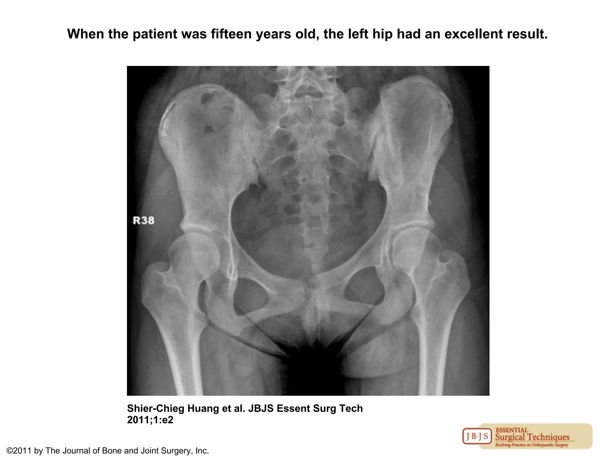 When the patient was fifteen years old, the left hip had an excellent result.
Shier-Chieg Huang et al. JBJS Essent Surg Tech
2011;1:e2
©2011 by The Journal of Bone and Joint Surgery, Inc.
 
