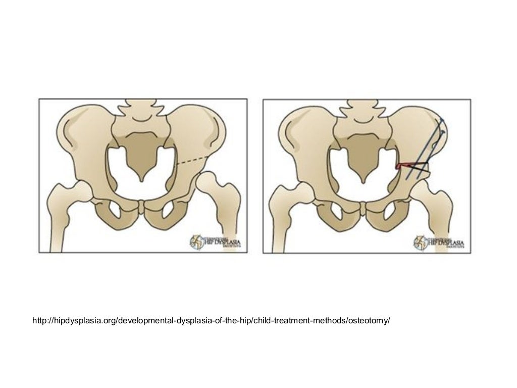 Pemberton's Osteotomy for Acetabular Dysplasia