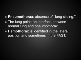 Pneumothorax: absence of ‘‘lung sliding.’’
The lung point: an interface between
normal lung and pneumothorax.
Hemothorax is identified in the lateral
position and sometimes in the FAST.
 