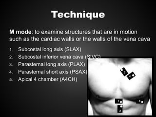 Technique
M mode: to examine structures that are in motion
such as the cardiac walls or the walls of the vena cava
1. Subcostal long axis (SLAX)
2. Subcostal inferior vena cava (SIVC)
3. Parasternal long axis (PLAX)
4. Parasternal short axis (PSAX)
5. Apical 4 chamber (A4CH)
 