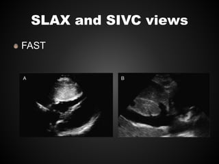SLAX and SIVC views
FAST
 
