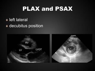 PLAX and PSAX
left lateral
decubitus position
LV LVOT
RV
RV
LV
 