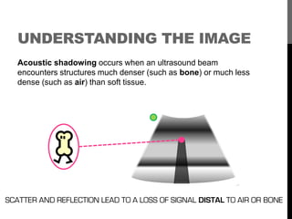 UNDERSTANDING THE IMAGE
   Acoustic shadowing occurs when an ultrasound beam
   encounters structures much denser (such as...