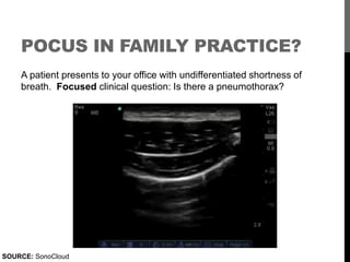 POCUS IN FAMILY PRACTICE?
    A patient presents to your office with undifferentiated shortness of
    breath. Focused cli...