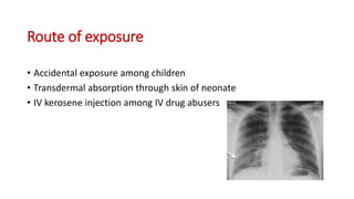 Route of exposure
• Accidental exposure among children
• Transdermal absorption through skin of neonate
• IV kerosene injection among IV drug abusers
 