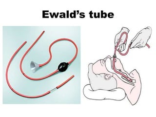 Ewald’s tube
 