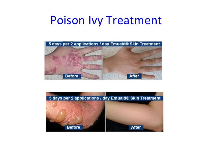 Poison ivy treatment