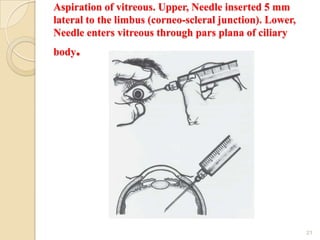 Aspiration of vitreous. Upper, Needle inserted 5 mm
lateral to the limbus (corneo-scleral junction). Lower,
Needle enters vitreous through pars plana of ciliary
body.
21
 