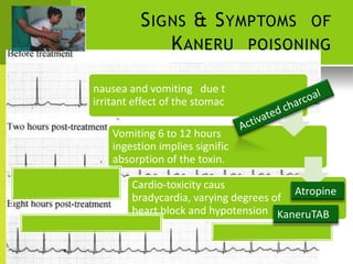 o local 
h 
after ant 
es 
SIGNS & SYMPTOMS OF 
KANERU POISONING 
nausea and vomiting due t 
irritant effect of the stomac 
Vomiting 6 to 12 hours ingestion implies signific absorption of the toxin. 
Cardio-toxicity caus bradycardia, varying degrees of 
Atropine 
heart block and hypotension 
KaneruTAB  