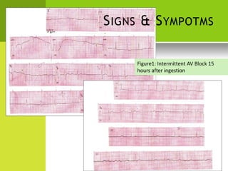 SIGNS & SYMPOTMS 
Figure1: Intermittent AV Block 15 
hours after ingestion  