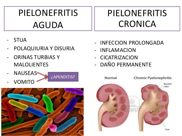 Polaquiuria Y Disuria Polaquiuria Y Disuria