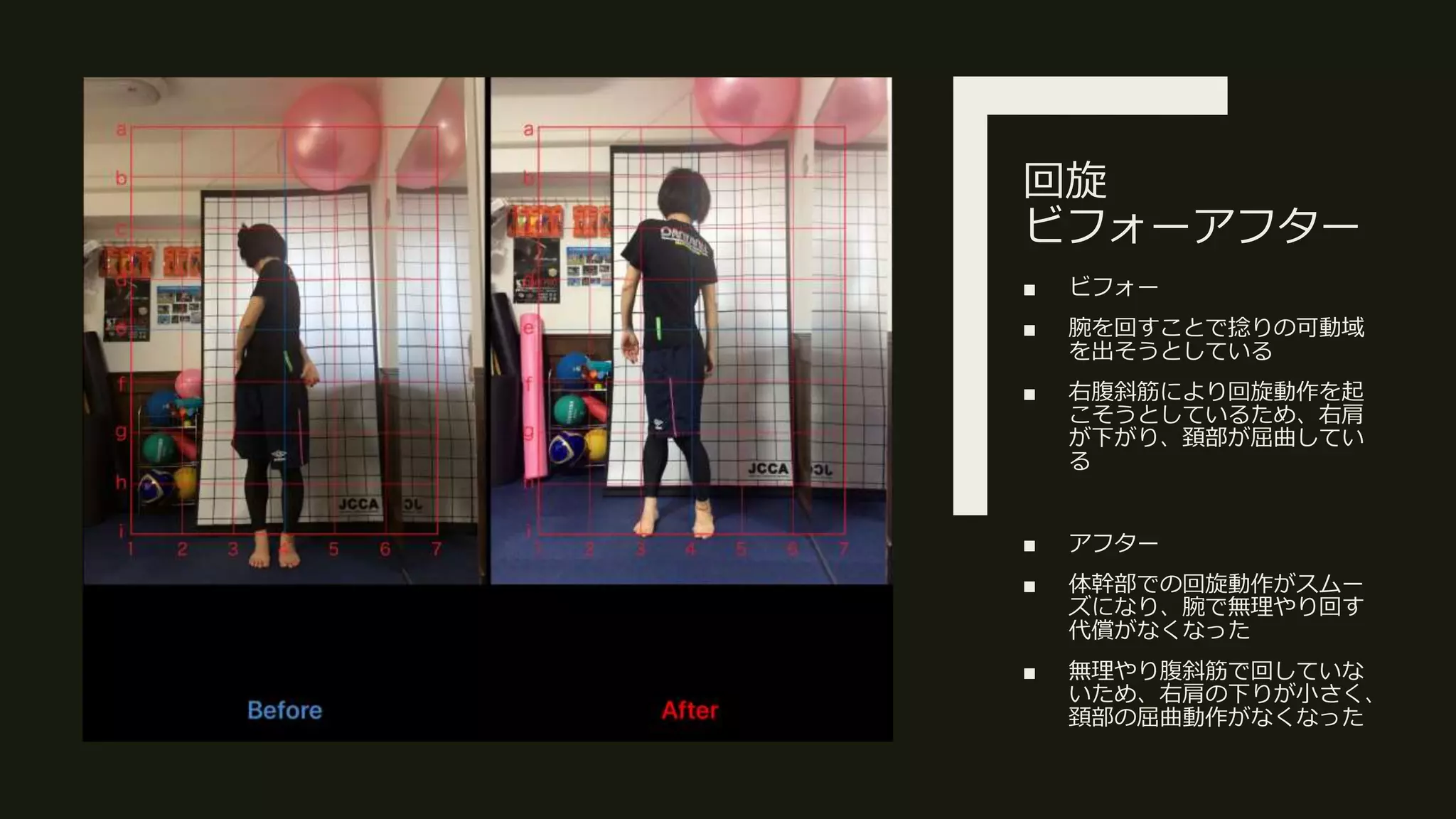 回旋
ビフォーアフター
■ ビフォー
■ 腕を回すことで捻りの可動域
を出そうとしている
■ 右腹斜筋により回旋動作を起
こそうとしているため、右肩
が下がり、頚部が屈曲してい
る
■ アフター
■ 体幹部での回旋動作がスムー
ズになり、腕で無理やり回す
代償がなくなった
■ 無理やり腹斜筋で回していな
いため、右肩の下りが小さく、
頚部の屈曲動作がなくなった
 