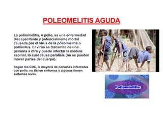 POLEOMELITIS AGUDA
La poliomielitis, o polio, es una enfermedad
discapacitante y potencialmente mortal
causada por el virus de la poliomielitis o
poliovirus. El virus se transmite de una
persona a otra y puede infectar la médula
espinal, lo cual causa parálisis (no se pueden
mover partes del cuerpo).
Según los CDC, la mayoría de personas infectadas
con polio, no tienen síntomas y algunas tienen
síntomas leves.
 