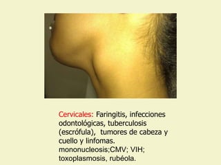 Cervicales: Faringitis, infecciones
odontológicas, tuberculosis
(escrófula), tumores de cabeza y
cuello y linfomas.
mononucleosis;CMV; VIH;
toxoplasmosis, rubéola.
 