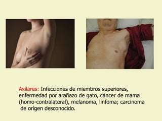 Axilares: Infecciones de miembros superiores,
enfermedad por arañazo de gato, cáncer de mama
(homo-contralateral), melanoma, linfoma; carcinoma
 de orígen desconocido.
 