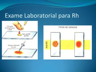 Exame Laboratorial para Rh
 