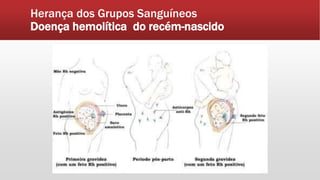 Herança dos Grupos Sanguíneos
Doença hemolítica do recém-nascido
 