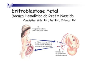 Eritroblastose Fetal
Doença Hemolítica do Recém Nascido
Condições: Mãe: Rh-; Pai: Rh+; Criança: Rh+
 