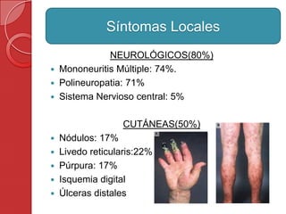 NEUROLÓGICOS(80%)
 Mononeuritis Múltiple: 74%.
 Polineuropatia: 71%
 Sistema Nervioso central: 5%
CUTÁNEAS(50%)
 Nódulos: 17%
 Livedo reticularis:22%
 Púrpura: 17%
 Isquemia digital
 Úlceras distales
Síntomas Locales
 