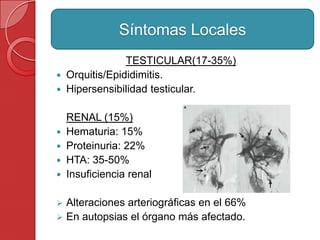 TESTICULAR(17-35%)
 Orquitis/Epididimitis.
 Hipersensibilidad testicular.
RENAL (15%)
 Hematuria: 15%
 Proteinuria: 22%
 HTA: 35-50%
 Insuficiencia renal
 Alteraciones arteriográficas en el 66%
 En autopsias el órgano más afectado.
Síntomas Locales
 