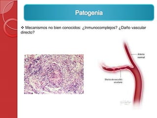  Mecanismos no bien conocidos: ¿Inmunocomplejos? ¿Daño vascular
directo?
 