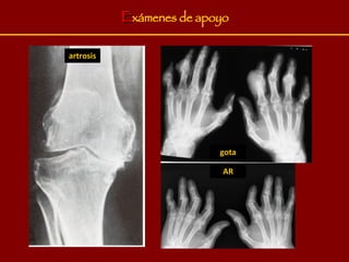 E xámenes de apoyo artrosis AR gota 