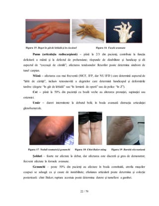 22 / 79
Figura 15 Deget în gât de lebădă şi în ciocănel Figura 16 Fazele avansate
Pumn (articulaţia radiocarpiană) – până la 2/3 din pacienţi, contribuie la funcţia
deficitară a mâinii şi la defectul de prehensiune; răspunde de dizabilitate şi handicap şi dă
aspectul de “cocoaşă de cămilă”; afectarea tendoanelor flexorilor poate determina sindrom de
tunel carpian.
Mână – afectarea cea mai frecventă (MCF, IFP, dar NU IFD ) care determină aspectul de
“labă de cârtiţă”, inclusiv tenosinovită a degetelor care determină handicapul şi deformările
tardive (degete “în gât de lebădă” sau “în lornietă de operă” sau de police “în Z”).
Cot – până la 50% din pacienţii cu boală veche au alterarea pronaţiei, supinaţiei sau
extensiei.
Umăr – dureri intermitente la debutul bolii; în boala avansată distrucţia articulaţiei
glenohumerale.
Figura 17 Noduli reumatoizi genunchi Figura 18 Chist Baker stâng Figura 19 Bursită olecraniană
Şolduri – foarte rar afectate la debut, dar afectarea este discretă şi greu de demonstrat;
frecvent afectate în formele avansate.
Genunchi – peste 50% din pacienţi au afectare în boala constituită, atrofia muşcilor
coapsei se adaugă ca şi cauze de instabilitate; efuziunea articulară poate determina şi colecţie
posterioară: chist Baker; ruptura acestuia poate determina durere şi tumefiere a gambei.
 