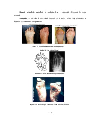 23 / 79
Gleznă, articulaţia subtalară şi mediotarsiene – determină deformări, în boala
avansată.
Antepicior – mai ales la caucasieni frecventă de la debut, haluce valg şi deviaţie a
degetelor cu deformarea antepiciorului.
Figura 20 Picior rheumatoid pre- şi postoperator
Figura 21 Picior rheumatoid tip triunghiular
Figura 22 Halux valgus, subluxaţii MTF, durioane plantare
 