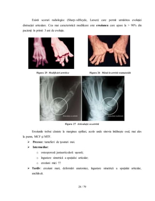 28 / 79
Există scoruri radiologice (Sharp-vdHeyde, Larsen) care permit urmărirea evoluţiei
distrucţiei articulare. Cea mai caracteristică modificare este eroziunea care apare la > 90% din
pacienţi în primii 3 ani de evoluţie.
Figura 25 Modificări artritice Figura 26 Mână în artrită reumatoidă
Figura 27 Articulaţie cu artrită
Eroziunile trebui căutate la marginea epifizei, acolo unde sinovia întâlneşte osul, mai ales
la pumn, MCF şi MTF.
 Precoce: tumefieri de ţesuturi moi.
 Intermediar:
o osteoporoză juxtaarticulară uşoară;
o îngustare simetrică a spaţiului articular;
o eroziuni mici !!!
 Tardiv: eroziuni mari, deformări anatomice, îngustare simetrică a spaţiului articular,
anchiloză.
 