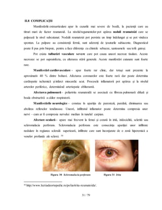 31 / 79
II.8 COMPLICAŢII
Manifestările extraarticulare apar în cazurile mai severe de boală, la pacienţii care au
titruri mari de factor reumatoid. La nivelul tegumentelor pot apărea noduli reumatoizi care se
palpează la nivel subcutanat. Nodulii reumatoizi pot persista un timp îndelungat şi se pot vindeca
spontan. La palpare au consistenţă fermă, sunt aderenţi de ţesuturile subiacente. Diagnosticul
poate fi pus prin biopsie, pentru a face diferenţa cu chistele sebacee, xantoamele sau tofii gutoşi.
Pot exista tulburări vasculare severe care pot cauza uneori necroze tisulare. Aceste
necrozee se pot suprainfecta, cu alterarea stării generale. Aceste manifestări cutanate sunt foarte
rare.
Manifestări cardiovasculare - apar foarte rar clinic, dar totuşi sunt prezente la
aproximativ 40 % dintre bolnavi. Afectarea coronarelor este foarte rară dar poate determina
cardiopatie ischemică şi infarct miocardic acut. Procesele inflamatorii pot apărea şi la nivelul
arterelor periferice, determinând arteriopatie obliterantă.
Afectarea pulmonară - poliartrita reumatoidă se asociază cu fibroza pulmonară difuză şi
boala obstructivă a căilor respiratorii.
Manifestările neurologice - constau în apariţia de parestezii, paralizii, diminuarea sau
abolirea reflexelor tendinoase. Uneori, infiltratul inflamator poate determina compresia unor
nervi – cum ar fi compresia nervului median în tunelul carpian.
Afectare oculară - apare mai frecvent la femei şi constă în irită, iridociclită, sclerită sau
scleromalacia perforans. Scleromalacia perforans este consecinţa apariţiei unor infiltrate
nodulare în regiunea sclerală superioară, infiltrate care sunt înconjurate de o zonă hiperemică a
venelor profunde ale sclerei. 30
Figura 30 Scleromalacia perforans Figura 31 Irita
30
http://www.lectiadeortopedie.ro/poliartrita-reumatoida/.
 
