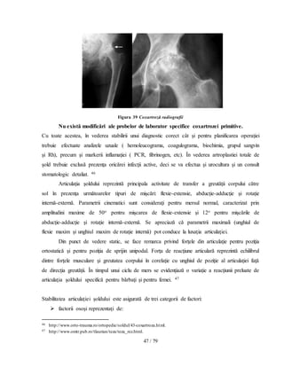47 / 79
Figura 39 Coxartroză radiografii
Nu există modificări ale probelor de laborator specifice coxartrozei primitive.
Cu toate acestea, în vederea stabilirii unui diagnostic corect cât şi pentru planificarea operaţiei
trebuie efectuate analizele uzuale ( hemoleucograma, coagulograma, biochimia, grupul sangvin
şi Rh), precum şi markerii inflamaţiei ( PCR, fibrinogen, etc). În vederea artroplastiei totale de
şold trebuie exclusă prezenţa oricărei infecţii active, deci se va efectua şi urocultura şi un consult
stomatologic detaliat. 46
Articulaţia şoldului reprezintă principala activitate de transfer a greutăţii corpului către
sol în prezenţa următoarelor tipuri de mişcări: flexie-extensie, abducţie-adducţie şi rotaţie
internă-externă. Parametrii cinematici sunt consideraţi pentru mersul normal, caracterizat prin
amplitudini maxime de 50o pentru mişcarea de flexie-extensie şi 12o pentru mişcările de
abducţie-adducţie şi rotaţie internă-externă. Se apreciază că parametrii maximali (unghiul de
flexie maxim şi unghiul maxim de rotaţie internă) pot conduce la luxaţia articulaţiei.
Din punct de vedere static, se face remarca privind forţele din articulaţie pentru poziţia
ortostatică şi pentru poziţia de sprijin unipodal. Forţa de reacţiune articulară reprezintă echilibrul
dintre forţele musculare şi greutatea corpului în corelaţie cu unghiul de poziţie al articulaţiei faţă
de direcţia greutăţii. În timpul unui ciclu de mers se evidenţiază o variaţie a reacţiunii preluate de
articulaţia şoldului specifică pentru bărbaţi şi pentru femei. 47
Stabilitatea articulației șoldului este asigurată de trei categorii de factori:
 factorii osoşi reprezentaţi de:
46 http://www.orto-trauma.ro/ortopedie/soldul/43-coxartroza.html.
47 http://www.omtr.pub.ro/tlaurian/teza/teza_rez.html.
 