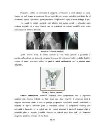 53 / 79
Protezarea şoldului se adresează în proporţie covârşitoare la două afecţiuni şi anume
fractura de col femural şi coxartroza. Scopul operaţiei este redarea mobilităţii articulaţiei dar şi
mobilizarea rapidă a pacientului pentru prevenirea complicaţiilor legate de statul prelungit la pat.
De regulă în stadiile operabile sunt afectate atât partea coxală a articulaţiei adică
cavitatea cotiloidă cât şi capul femural care se articulează cu cavitatea cotiloidă motiv pentru
care amândouă trebuiesc înlocuite.
Figura 41 Coxartroza radiologic
Astăzi, această boală, în stadiile avansate şi când starea generală a pacientului o
permite are/beneficiază de tratament chirurgical şi anume de protezarea totală a şoldului. Există 2
variante şi anume protezarea şoldului cu proteză totală necimentată sau cu proteză totală
cimentată.
Figura 42 Proteza cimentată
Proteza necimentată realizează potrivirea dintre componentele sale şi organismul
acceptor prin frecarea (pilirea) cu freze (pile) care cresc progresiv în dimensiuni până la
atingerea dimensiunii dorite în ceea ce priveşte componenta acetabulară (coxală, cotiloidiană, a
bazinului) în fapt o hemisferă goală şi articularea acesteia cu componenta femurală care
reprezintă o hemisferă ce se aplică unei tije (pene) introdusă în interiorul femurului după o
prealabilă pilire a acestuia (canalului femural) cu ajutorul unor freze (pile) de dimensiuni
progresive până la o potrivire cât mai bună.
 