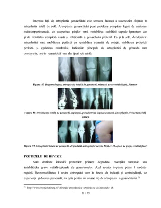 71 / 79
Interesul faţă de artroplastia genunchiului este urmarea firească a succceselor obţinute în
artroplastia totală de şold. Artroplastia genunchiului pune probleme complexe legate de anatomia
multicompartimentală, de acoperirea părţilor moi, restabilirea stabilităţii capsulo-ligmentare dar
şi de motilitatea complexă axială şi rotaţională a genunchiului protezat. Ca şi la şold, dezideratele
artroplastiei sunt: mobilitatea perfectă cu restabilirea centrului de rotaţie, stabilitatea protetică
perfectă şi egalizarea membrelor. Indicaţiile principale ale artroplastiei de genunchi sunt
osteoartrita, artrita reumatoidă sau alte tipuri de artrită.
Figura 57 Dezartrodezare, artroplastie totală de genunchi, primară, posterostabilizată, Zimmer
Figura 58 Artroplastie totală de genunchi, supurată, pseudartroză septică asanată, artroplastie revizie tumorală
GMRS
Figura 59 Artroplastie totală de genunchi, degradată,artroplastie revizie Stryker TS, aport de grefe, rezultat final
PROTEZELE DE REVIZIE
Sunt destinate înlocuirii protezelor primare degradate, rezecţiilor tumorale, sau
instabilităţilor grave multidirecţionale ale gonartrozelor. Axul acestor implante poate fi modular
reglabil. Responsabilitatea îi revine chirurgului care în funcţie de indicaţii şi contraindicaţii, de
experienţa şi dotarea personală, va opta pentru un anume tip de artroplastie a genunchiului.71
71 http://www.ortopedchirurg.ro/chirurgie-artroplastica~artroplastia-de-genunchi~15.
 