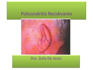 Policondritis Recidivante




    Dra. Zoila De Jesús
 