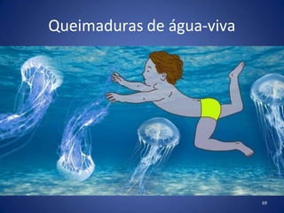 Queimaduras de água-viva
69
 