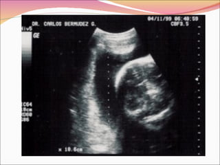 Polihidramnios y oligohidramnios