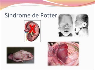 Polihidramnios y oligohidramnios