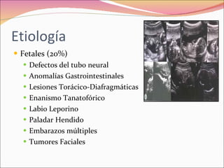 Polihidramnios y oligohidramnios