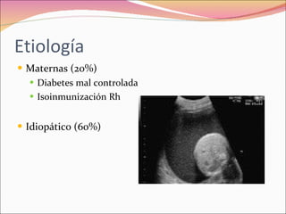 Polihidramnios y oligohidramnios