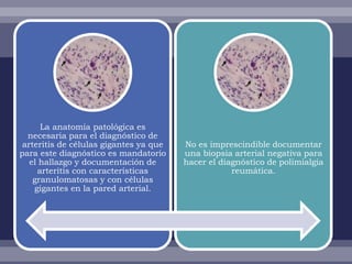 La anatomía patológica es
  necesaria para el diagnóstico de
 arteritis de células gigantes ya que   No es imprescindible documentar
para este diagnóstico es mandatorio     una biopsia arterial negativa para
   el hallazgo y documentación de       hacer el diagnóstico de polimialgia
     arteritis con características                  reumática.
    granulomatosas y con células
    gigantes en la pared arterial.
 