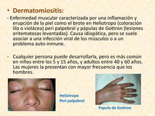 • Dermatomiositis:
- Enfermedad muscular caracterizada por una inflamación y
   erupción de la piel como el brote en Heliotropo (coloración
   lila o violácea) peri palpebral y pápulas de Gottron (lesiones
   eritematosas levantadas). Causa idiopática, pero se suele
   asociar a una infección viral de los músculos o a un
   problema auto-inmune.

- Cualquier persona puede desarrollarla, pero es más común
  en niños entre los 5 y 15 años, y adultos entre 40 y 60 años.
  Las mujeres la presentan con mayor frecuencia que los
  hombres.



                         Heliotropo
                         Peri palpebral
                                           Papula de Gottron
 