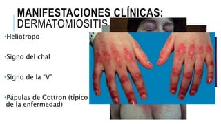 MANIFESTACIONES CLÍNICAS:
DERMATOMIOSITIS
•Heliotropo
•Signo del chal
•Signo de la “V”
•Pápulas de Gottron (típico
de la enfermedad)
 