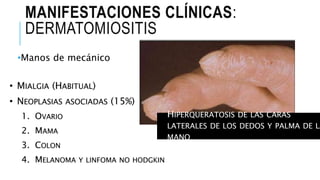 MANIFESTACIONES CLÍNICAS:
DERMATOMIOSITIS
•Manos de mecánico
• HIPERQUERATOSIS DE LAS CARAS
LATERALES DE LOS DEDOS Y PALMA DE LA
MANO
•
•
1.
2.
3.
4.
 