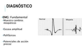 DIAGNÓSTICO
•EMG: Fundamental
•Muestra cambios
miopáticos
•Escasa amplitud
•Polifásicos
•Potenciales de acción
precoz
 