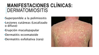 MANIFESTACIONES CLÍNICAS:
DERMATOMIOSITIS
•Superponible a la polimiositis
•Lesiones cutáneas (Localizado
o difuso)
•Erupción maculopapular
•Dermatitis eccematoide
•Dermatitis exfoliativa (rara)
 