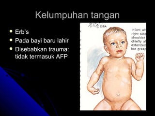 Kelumpuhan tangan
 Erb’s
 Pada

bayi baru lahir
 Disebabkan trauma:
tidak termasuk AFP

 