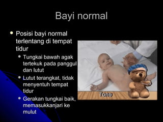 Bayi normal
 Posisi

bayi normal
terlentang di tempat
tidur
 Tungkai

bawah agak
tertekuk pada panggul
dan lutut
 Lutut terangkat, tidak
menyentuh tempat
tidur
 Gerakan tungkai baik,
memasukkanjari ke
mulut

 